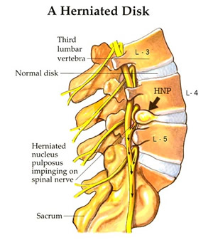 Herniated disc